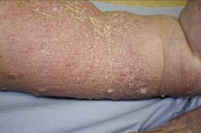 Figure 3 – Thickened skin with hyperkeratosis, papillomata and deep skin creases in a lymphoedematous leg